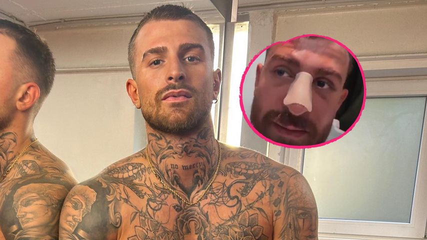 Not-OP bei Gigi: Nase war schon vor Fame Fighting kaputt