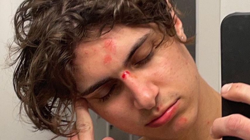 "Habe nicht nachgedacht": Lukas Rieger hat sich verletzt!