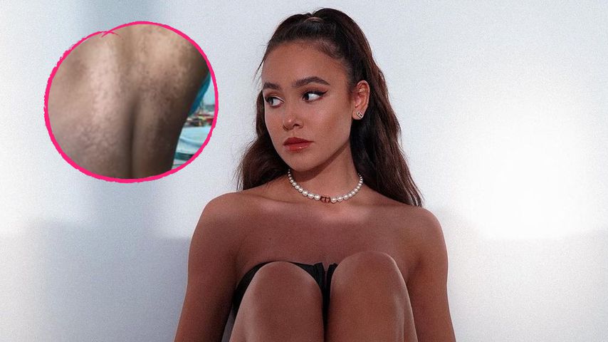 Maddy Nigmatullin geht offen mit ihrer Hautkrankheit um