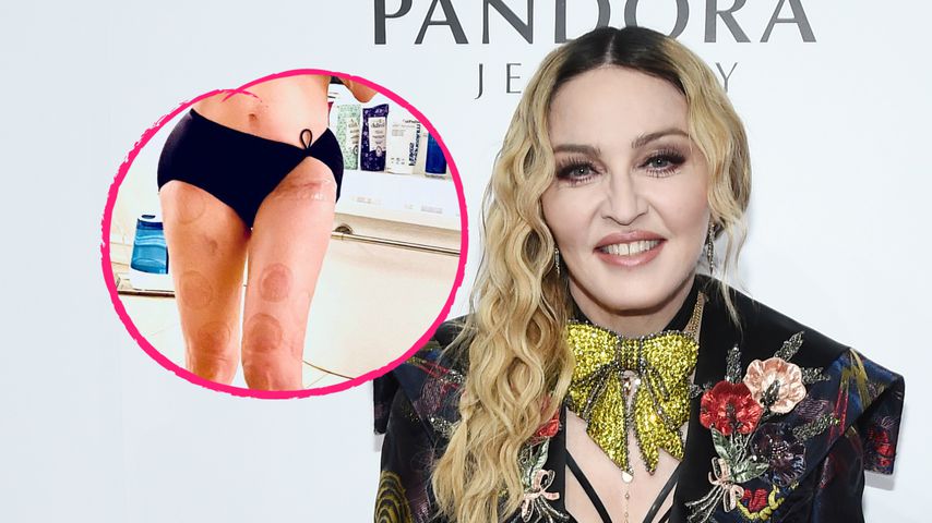 Madonna zeigt ihre Hüftnarbe und zahlreiche Schröpfmale