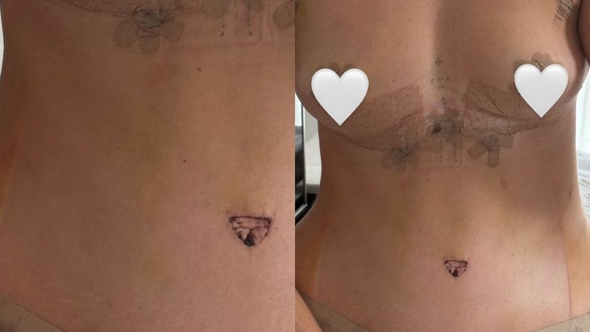 Maren Wolfs Körper nach der Brust-OP