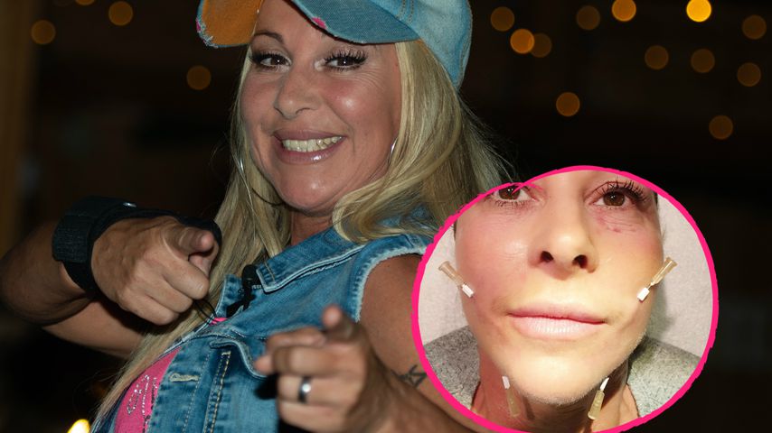 Autsch! Malle-Krümel zeigt sich mit Nadeln beim Face-Lifting