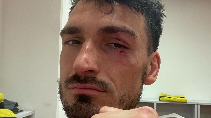 Tritt ins Gesicht: Mats Hummels kassiert dickes Veilchen!