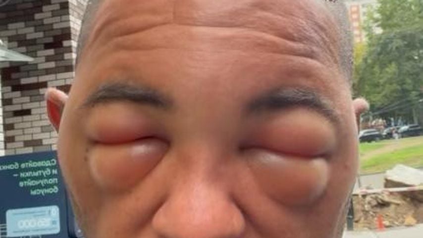 Max Jacobasch schockt nach Haar-OP mit geschwollenem Gesicht
