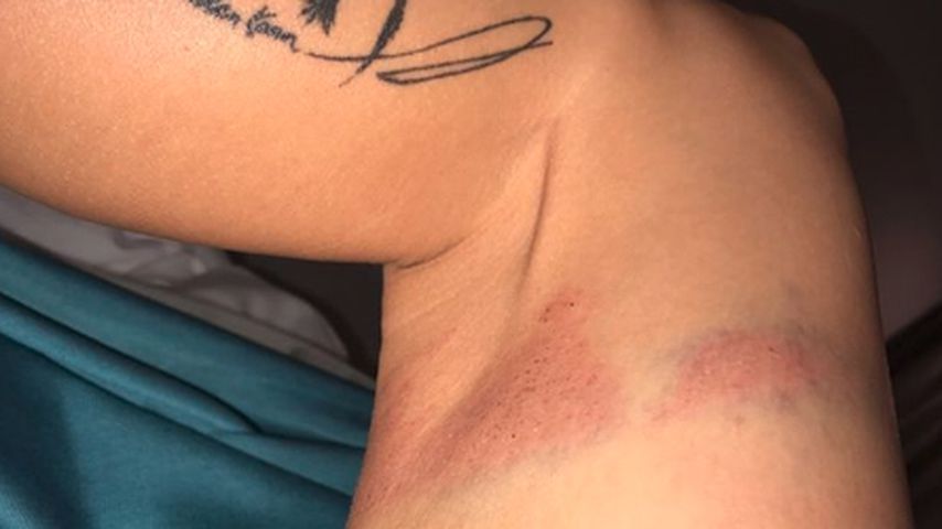 Mia Julias Verletzung nach dem Sturz