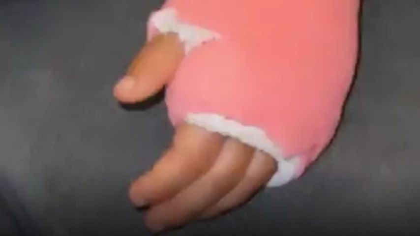 Mia Rose Harrisons gebrochener Arm