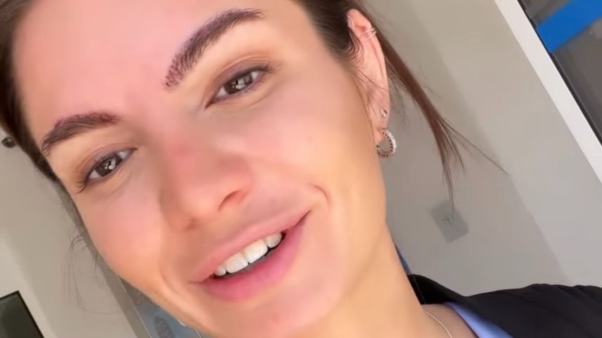 Haartransplantation: Michèle de Roos' Augenbrauen-Make-over