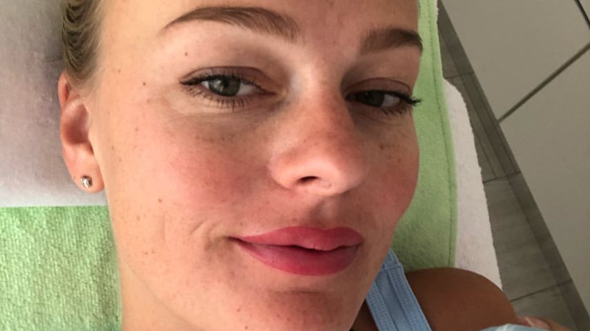 Miriam Höller nach der Pigmentierung ihrer Lippen