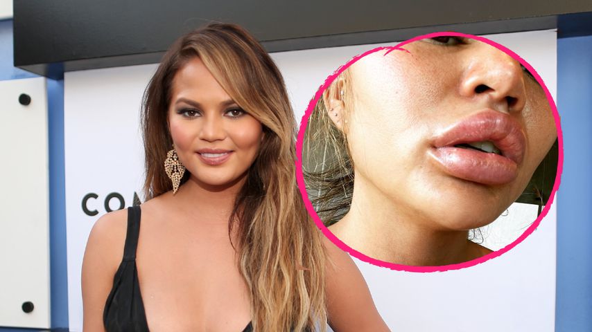 Chrissy Teigen mit XL-Lippen: War sie etwa beim Beauty-Doc?