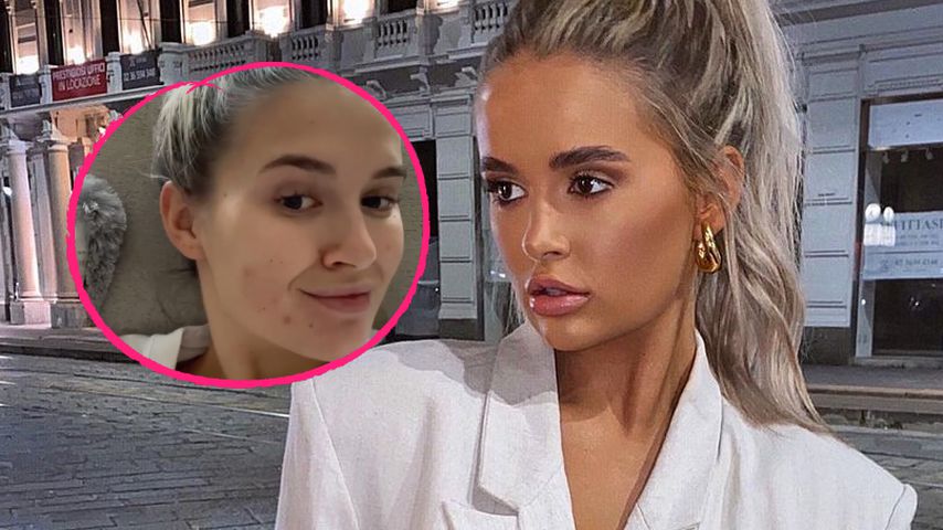 Nach Shitstorm: Molly-Mae Hague zeigt sich mit Akne im Netz