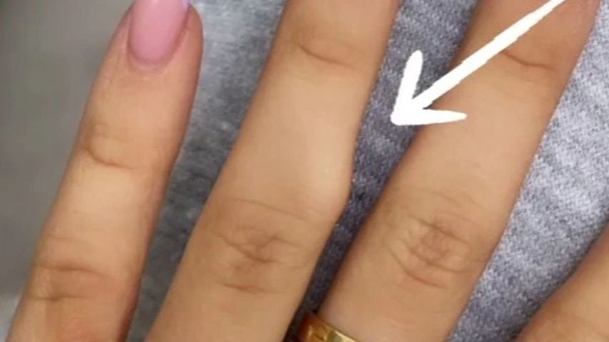 Molly-Mae Hagues Beule am Finger