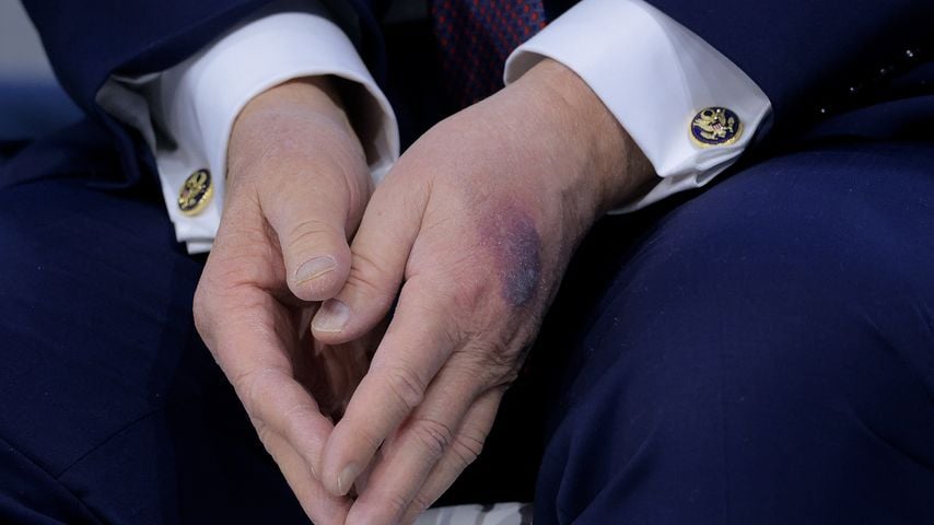 Ein blauer Fleck ziert die linke Hand des US-Präsidenten