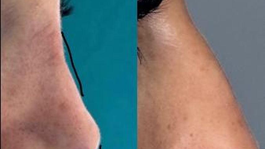 Sarah Liebichs Nase vor und nach der OP, November 2025