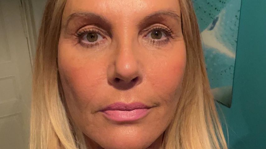 "Happy": Natascha Ochsenknecht zeigt Fadenlifting-Ergebnis