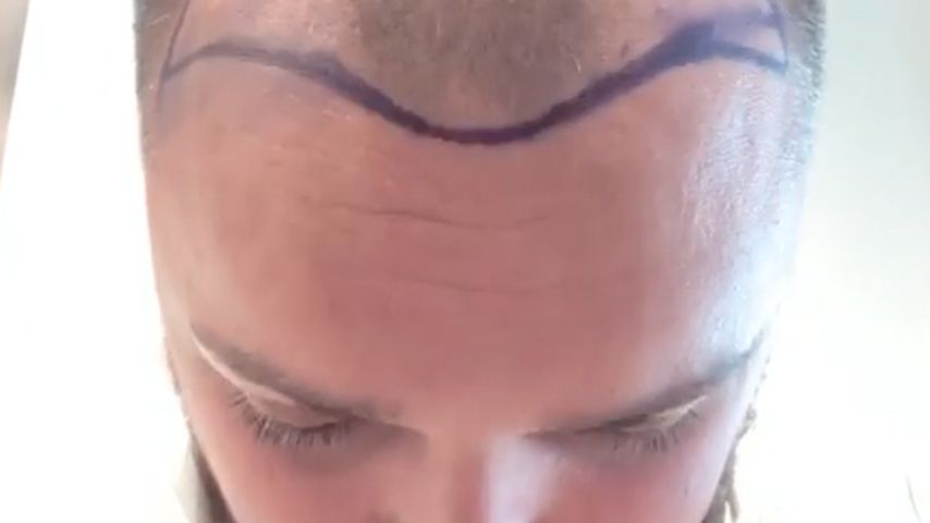 Hier unterzieht sich Nik Schröder einer Haartransplantation!