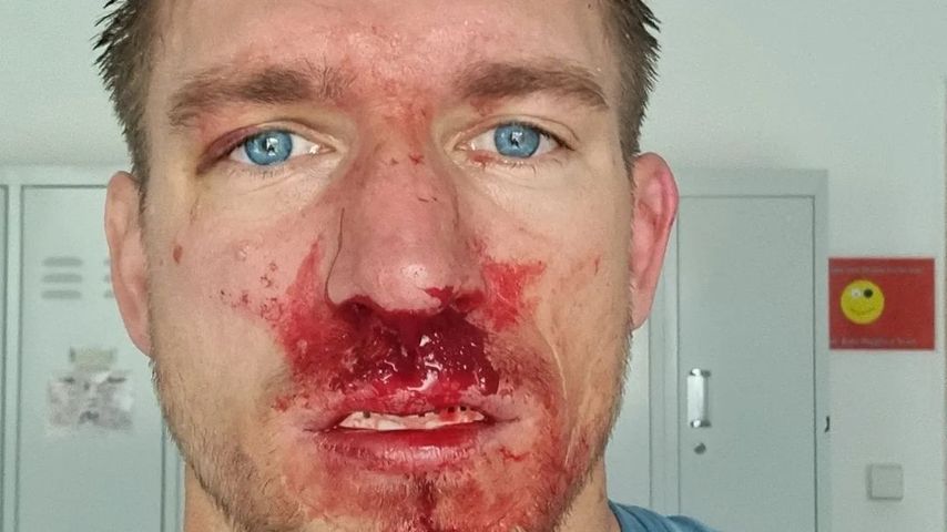 Patrick Fabian mit blutiger Nase