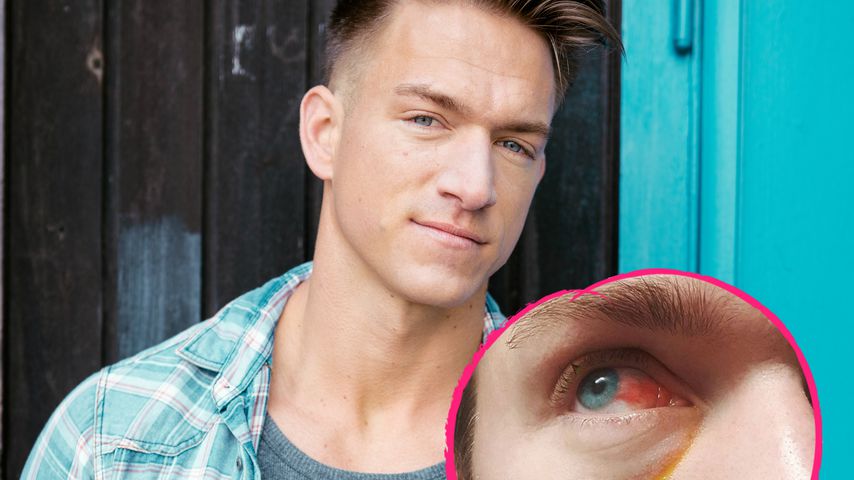 Fahrradunfall: Patrick Fabians Auge total blutunterlaufen