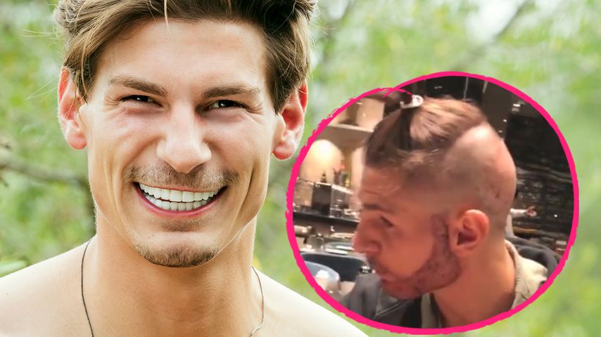 Beauty-OP: "Love Island"-Philipp macht Barttransplantation
