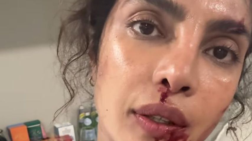 Nach Stuntverletzung: Priyanka Chopra zeigt sich blutig