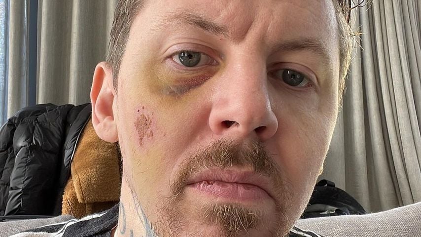 Professor Green zeigt seine Verletzungen vom April 2022