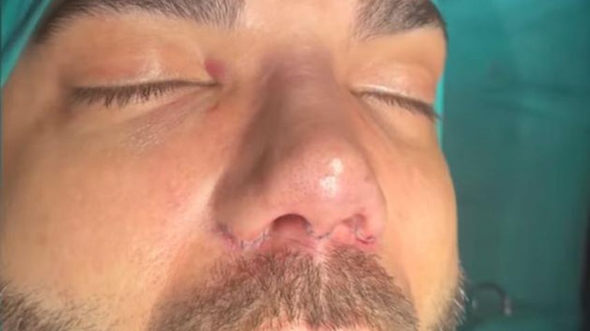 Vor der OP: Rafi Rachek fand seine alte Nase extrem hässlich