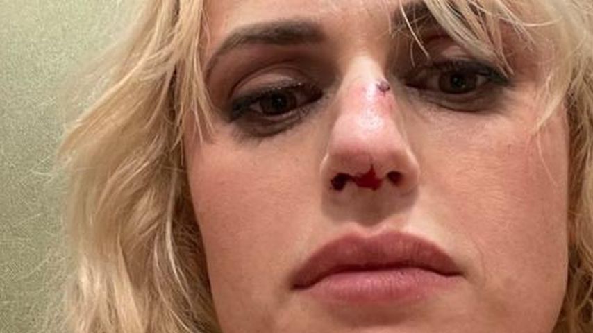 Autsch! Rebel Wilson zeigt blutende Nase nach Stunt-Unfall