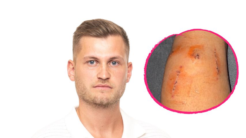 Normalo-Sommerhaus-Richard zeigt seine Knienarben nach OP