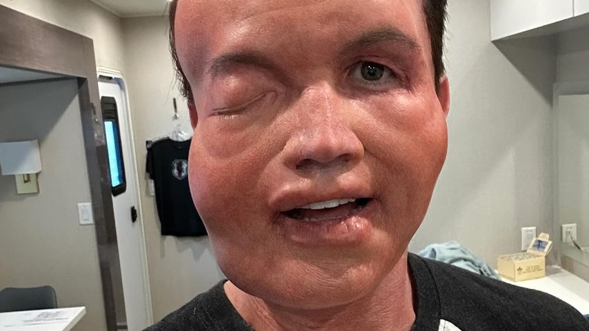 Nussallergie? Rob McElhenney zeigt stark verbeultes Gesicht