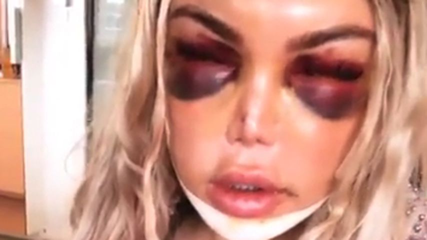 Rodrigo Alves nach seiner Gesichts-OP