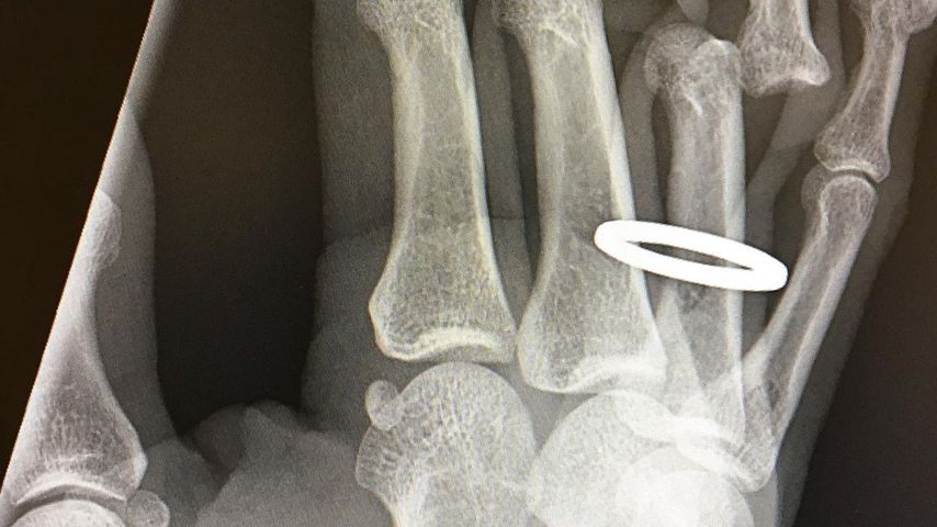 Röntgenaufnahme von Tony Hawks Hand