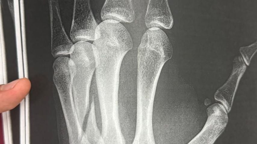 Röntgenbild von Kevin Njies Hand, Mai 2026