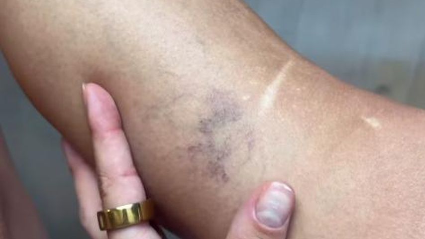 Romina Palms Bein während der Schwangerschaft