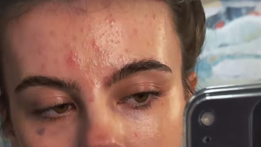 Seit Jahren Akne: Romina Palm teilt Video ihrer Unreinheiten