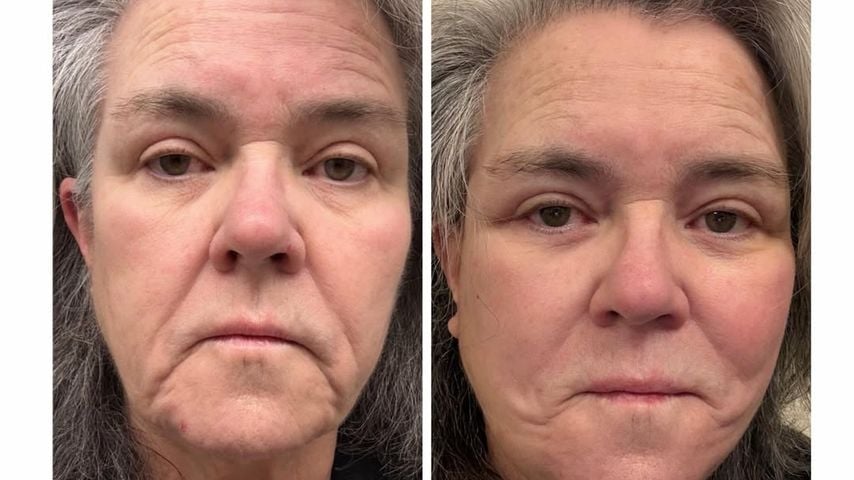 Geheimes Facelift: Rosie O'Donnell zeigt Vorher-Nachher-Foto