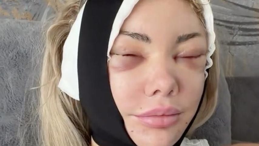 Realitystar Sabrina zeigt geschwollenes Gesicht nach Lifting