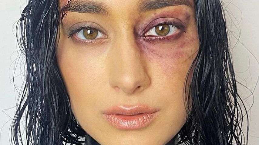 Sängerin Elif mit blauem Auge