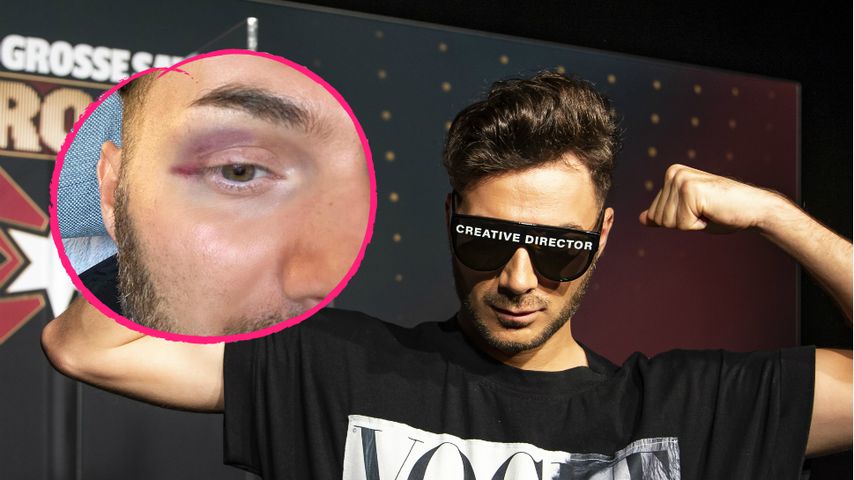 "Andenken von Serkan": Sam Dylan zeigt Promiboxen-Veilchen