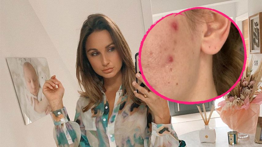 Sam Faiers wollte sich wegen schlimmer Akne wegsperren