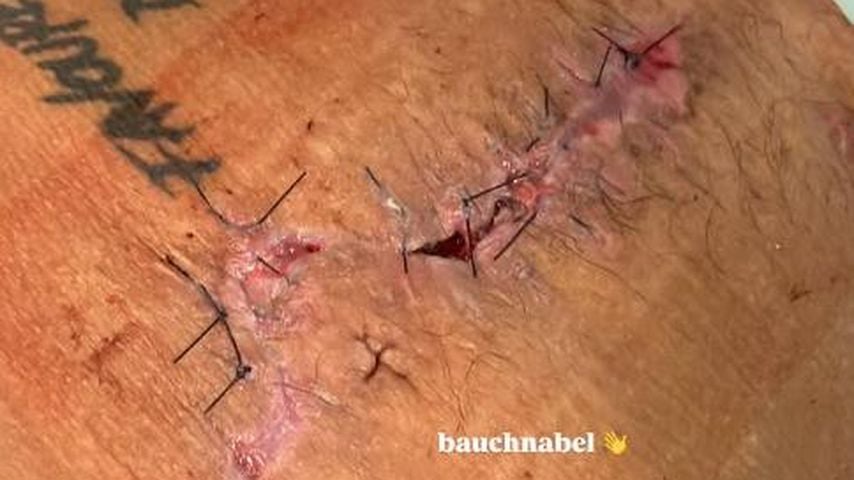 Samuel Dohmens Nahtwunde am Bauch, April 2026