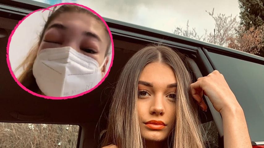 Ex-GNTM-Sarahs Gesicht bis zur Unkenntlichkeit angeschwollen
