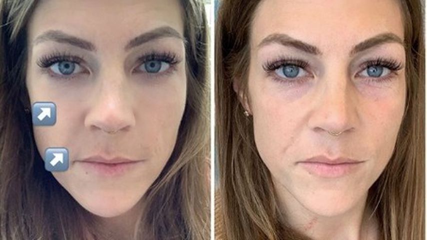 Saskia Beeks vor (rechts) und nach ihrer Hyaluron-Unterspritzung