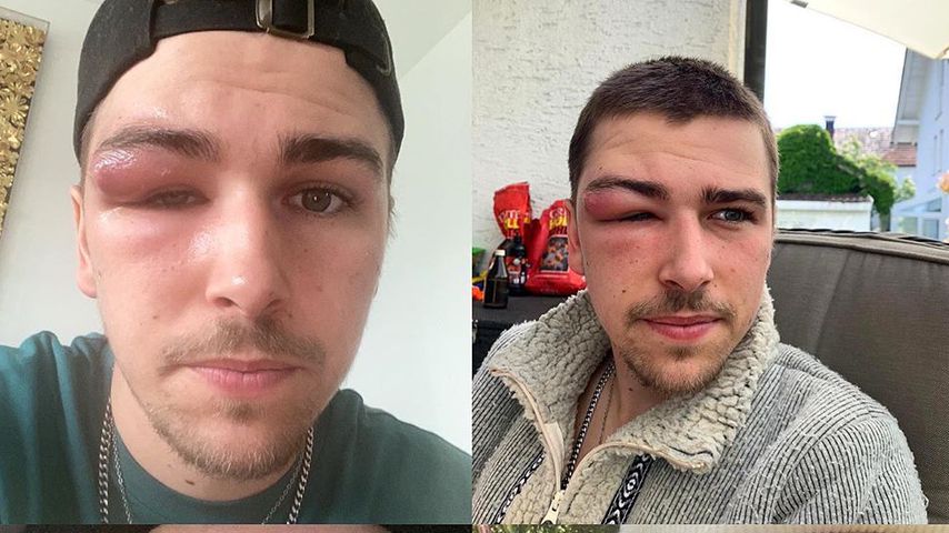 Zyste am Auge: Ex-BTN-Star Matze Höhn nicht wiederzuerkennen