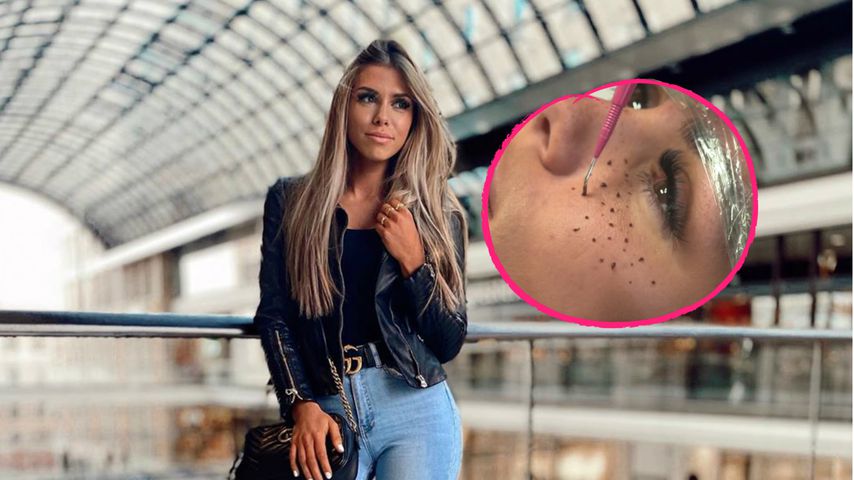 Hier bekommt BTN-Star Nathalie Bleicher-Woth Sommersprossen!