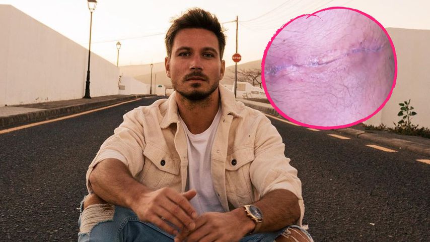 Nach Unfall mit Flex: Sebastian Pannek zeigt seine OP-Narbe
