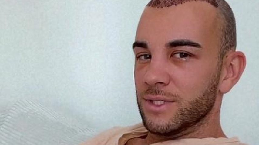Haartransplantation: Serkan Yavuz' Gesicht ist geschwollen