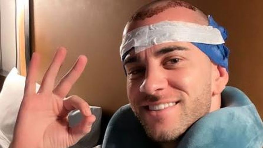 Haartransplantation bei Männern: Auch Serkan Yavuz machte es