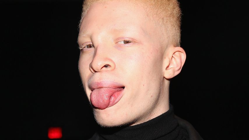 Albinomodel Shaun Ross: Hingucker auch ohne Kostüm