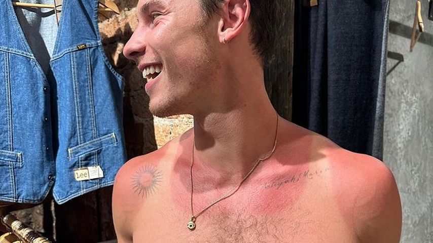 Shawn Mendes holte sich in Mexiko einen fetten Sonnenbrand