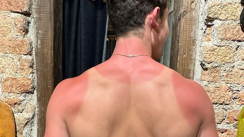 Shawn Mendes zeigt seinen Sonnenbrand