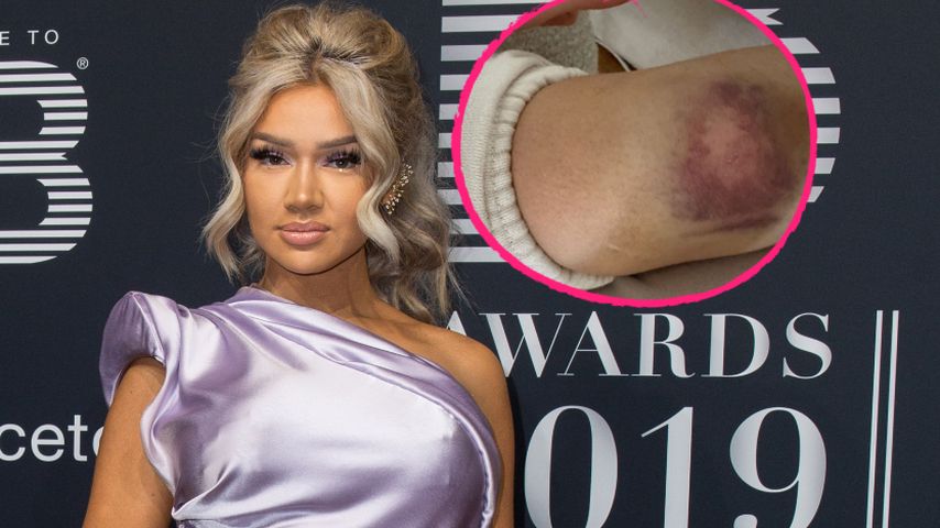 Nach Sturz von Treppe: Shirin David zeigt ihr kaputtes Knie